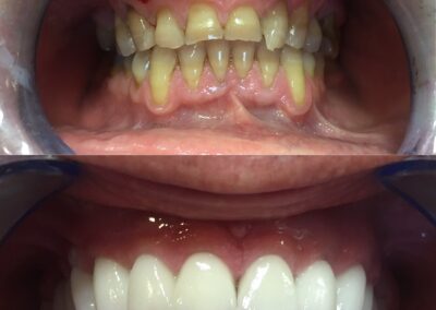 Bezmetalne krunice zuba